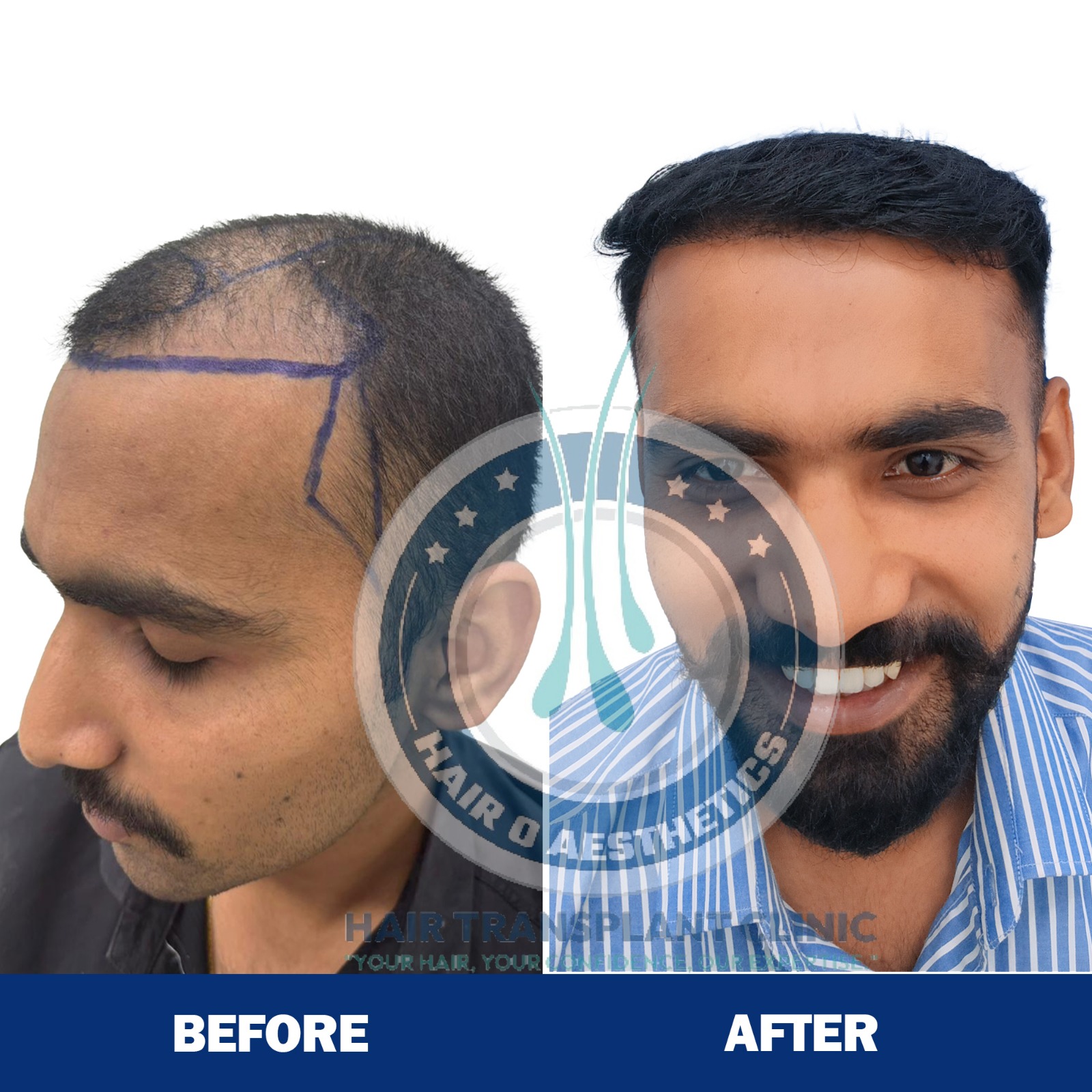 Hair Transplant Result 1