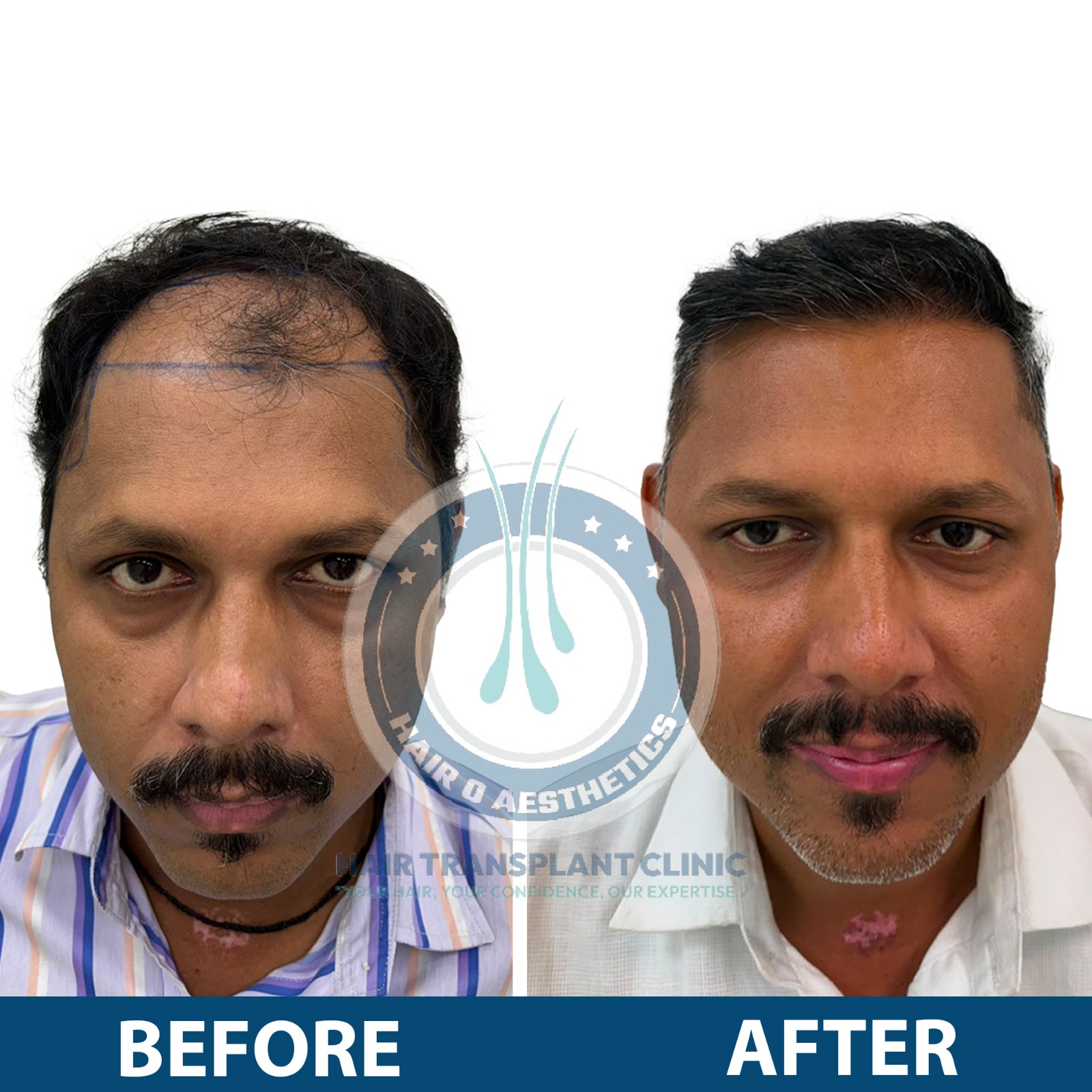 Hair Transplant Result 2