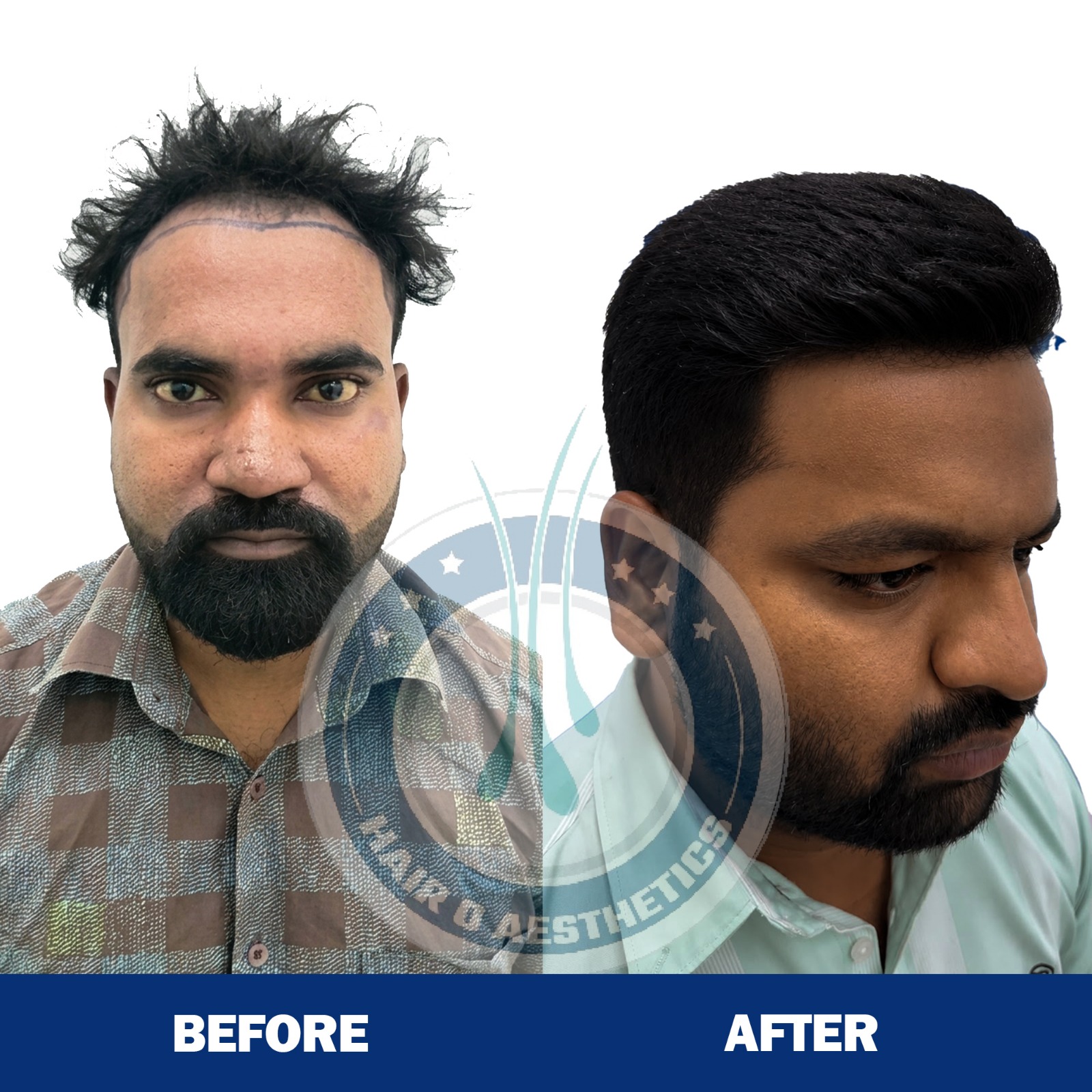 Hair Transplant Result 3