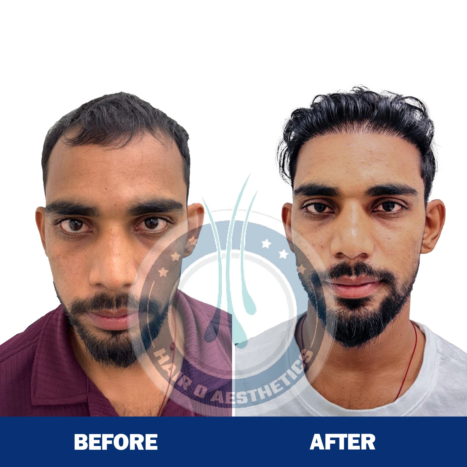 Hair Transplant Result 4