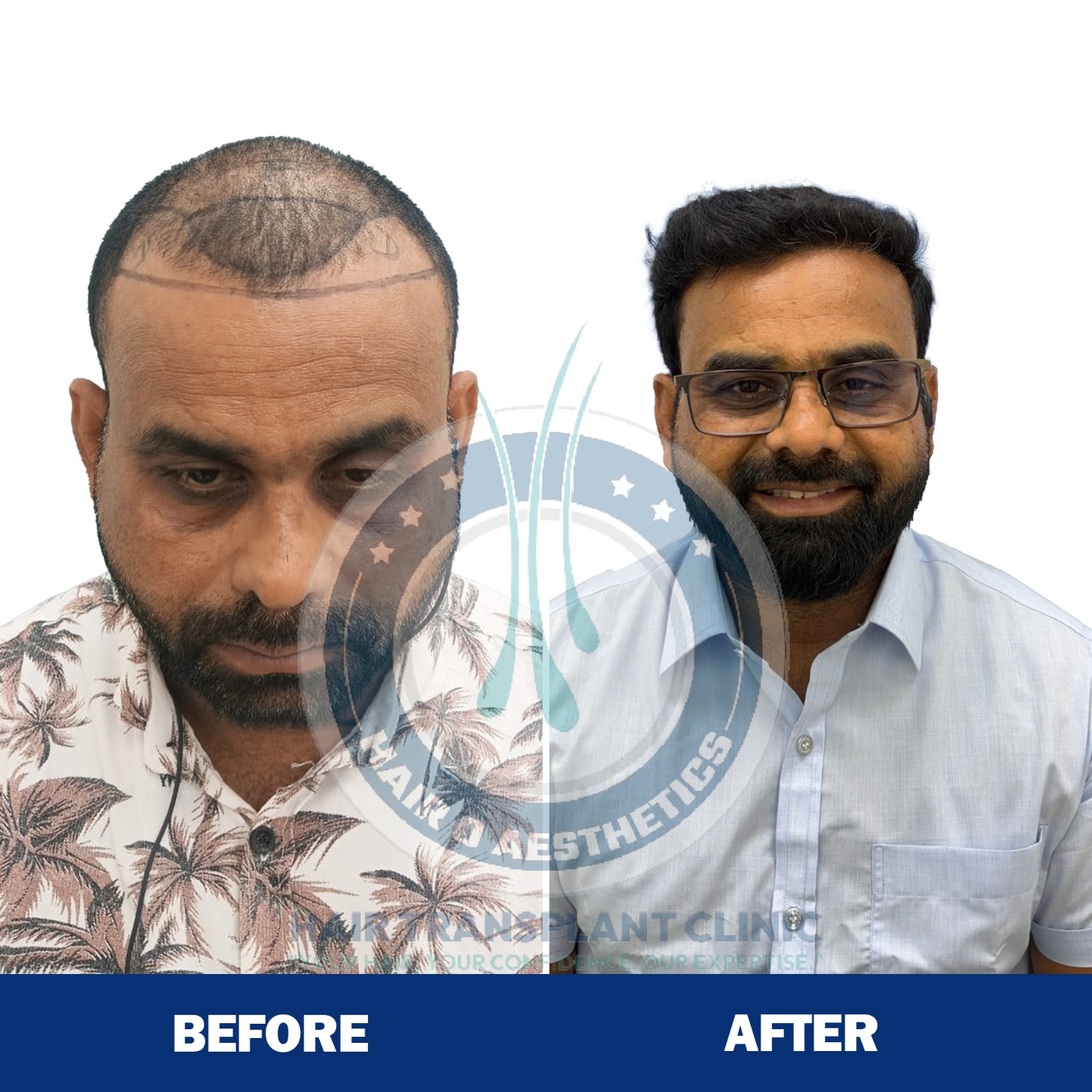 Hair Transplant Result 5