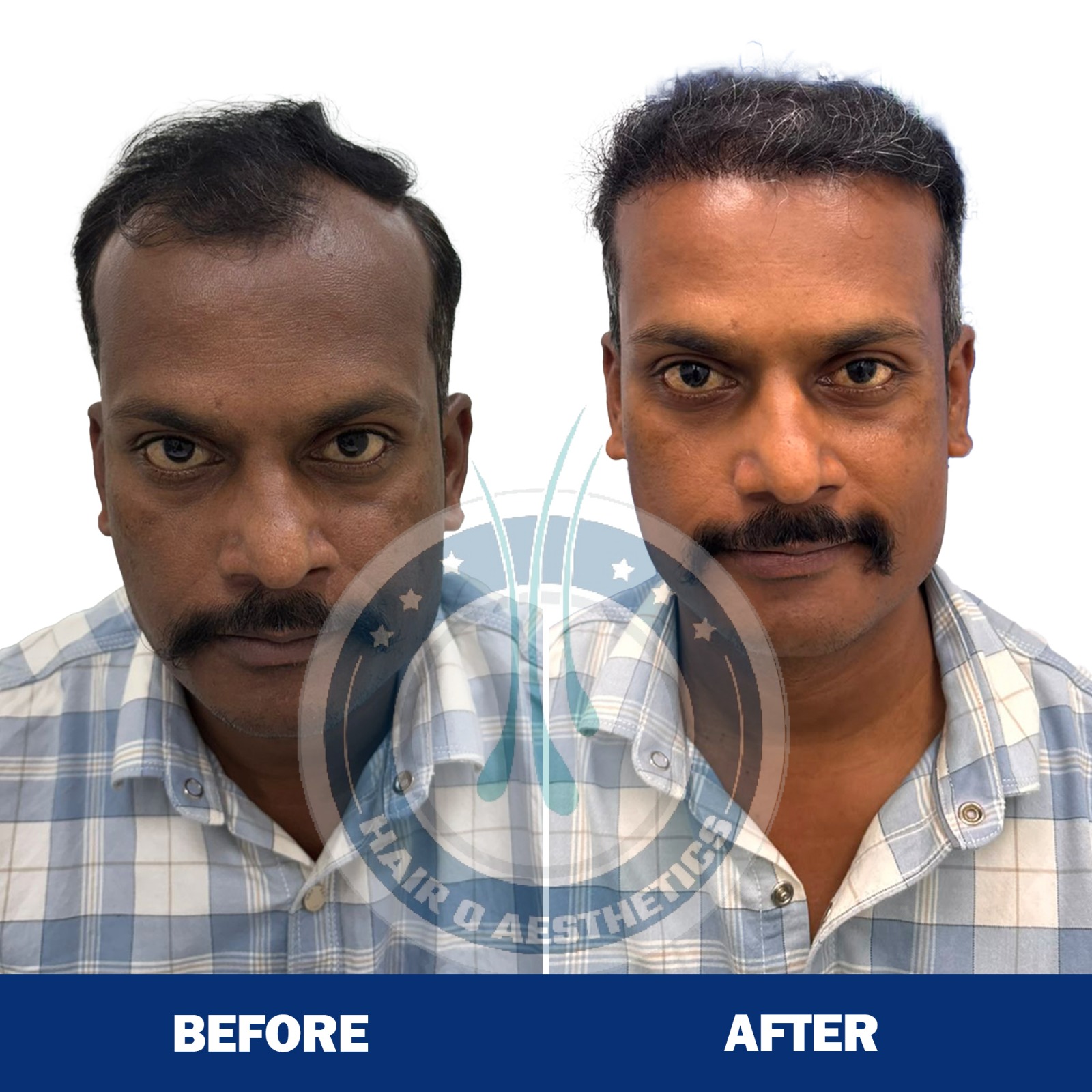 Hair Transplant Result 6
